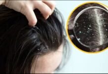 सर्दियों में डैंड्रफ से है परेशान, छुटकारा पाने के लिए आजमाएं ये घरेलू उपाय